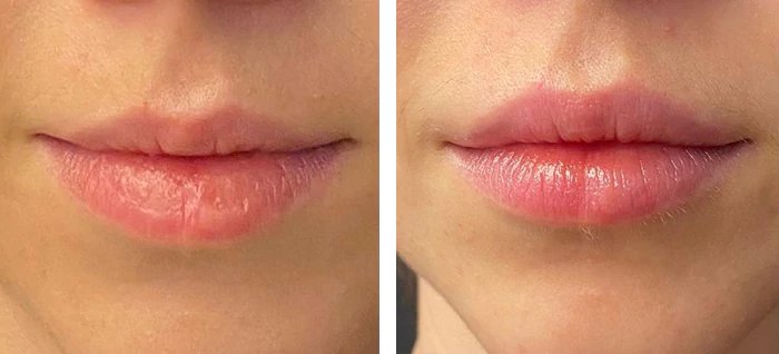 before & after photo of Nose Filler