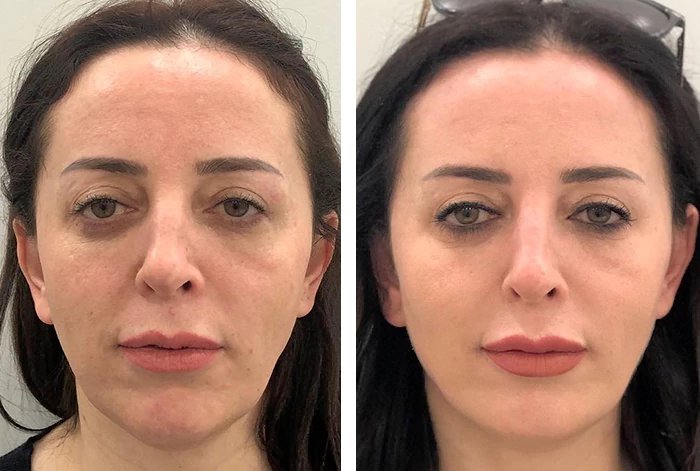 before & after photo of Lip Filler