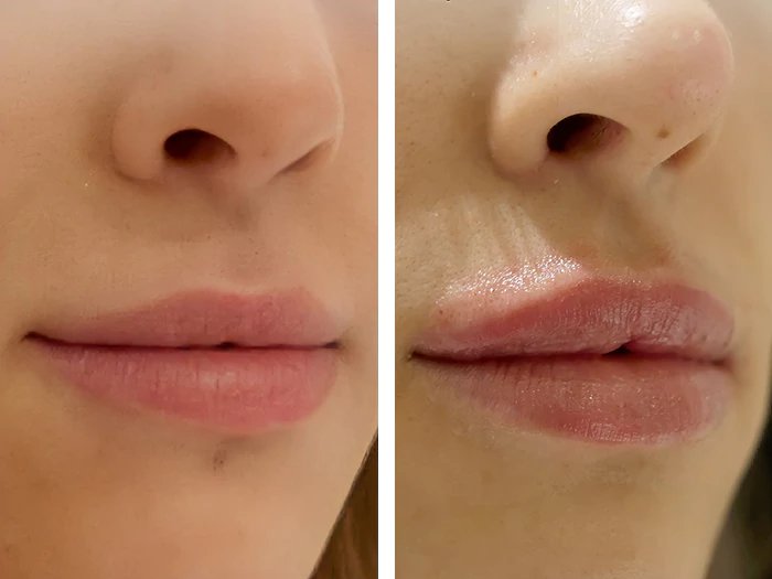 before & after photo of Thread Lift