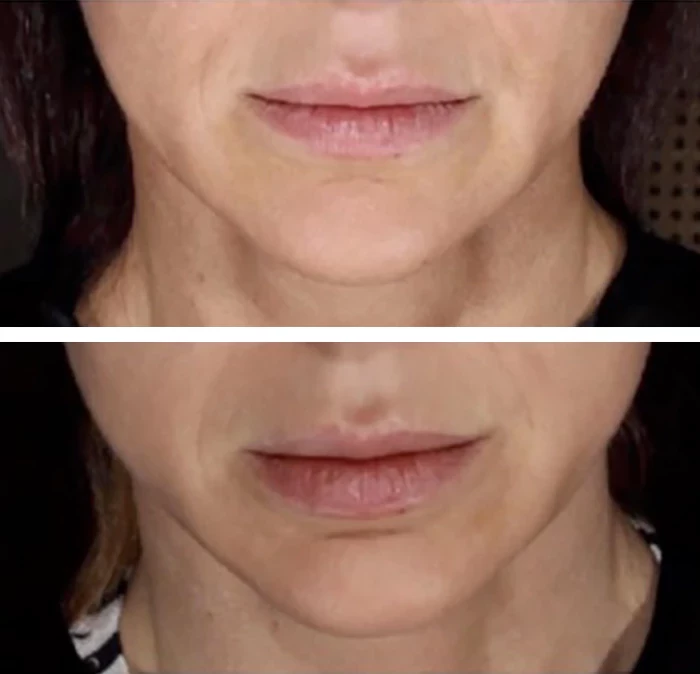 before & after photo of Chin and Jawline Filler
