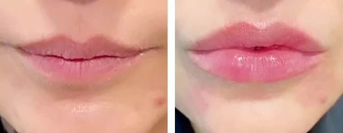 before & after photo of Nose Filler