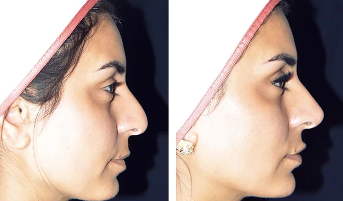 before & after photo of Rhinoplasty