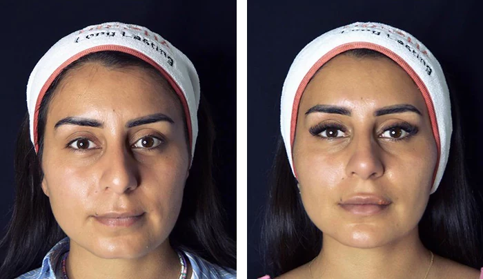 before & after photo of Rhinoplasty