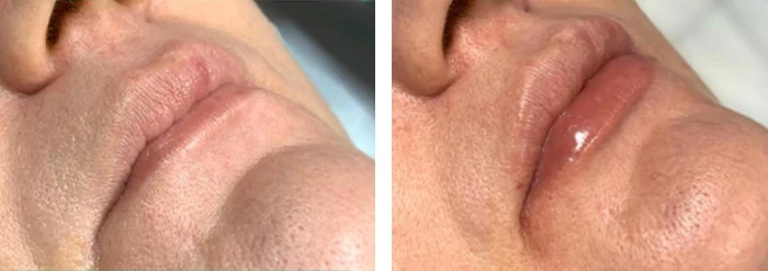 before & after photo of Lip Filler