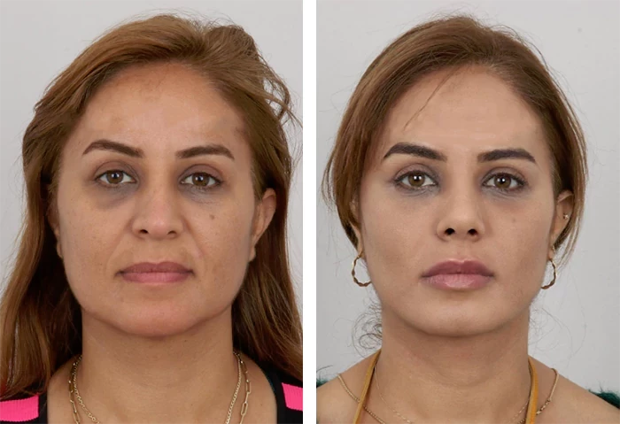 before & after photo of Rhinoplasty