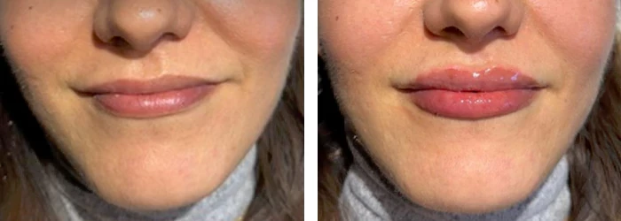 before & after photo of Lip Filler