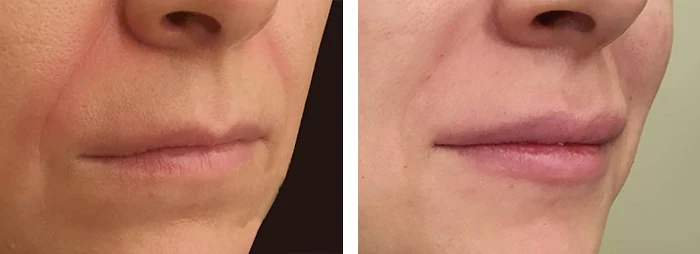 before & after photo of lip-filler