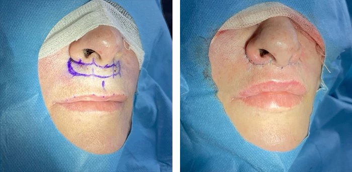 before & after photo of Lip Lift