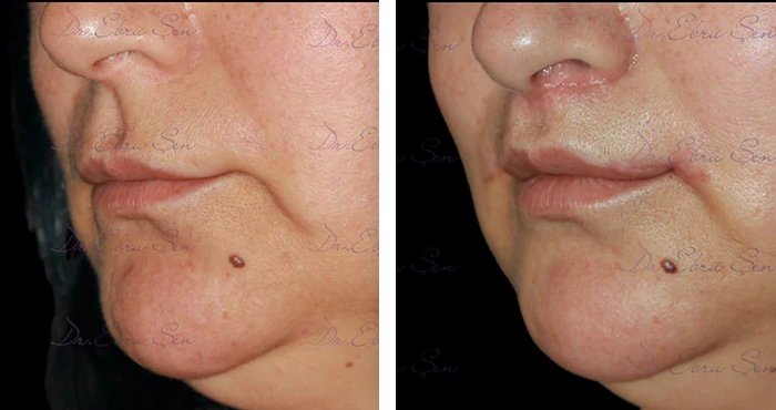 before & after photo of lip-lift