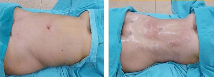 before & after photo of Tummy Tuck