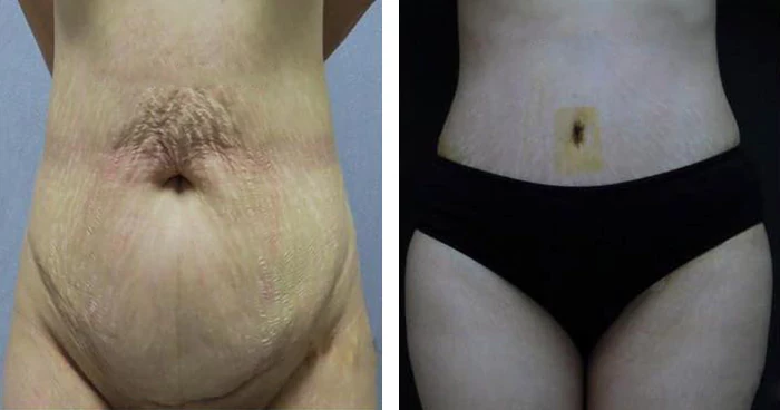 before & after photo of Liposuction