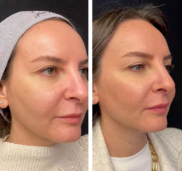 before & after photo of Mesotherapy