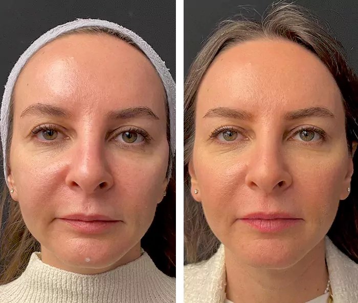 before & after photo of mesotherapy