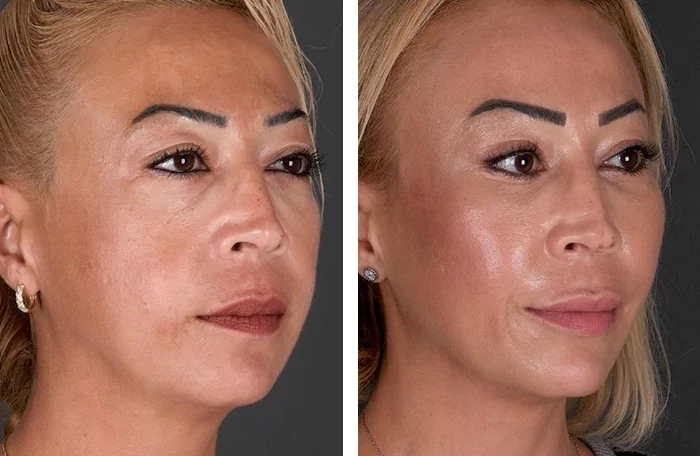 before & after photo of عملية تجميل الأنف