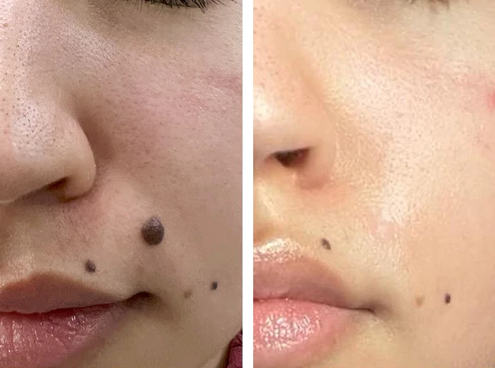 before & after photo of mole-removal-surgery