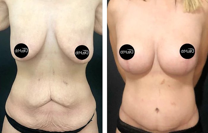 before & after photo of Tummy Tuck