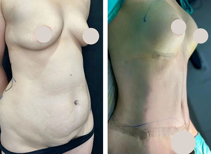 before & after photo of تجميل الجسم بعد الولادة