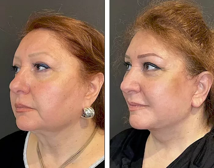 before & after photo of Brow Lift