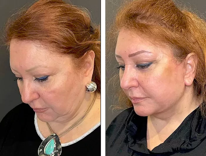 before & after photo of Brow Lift