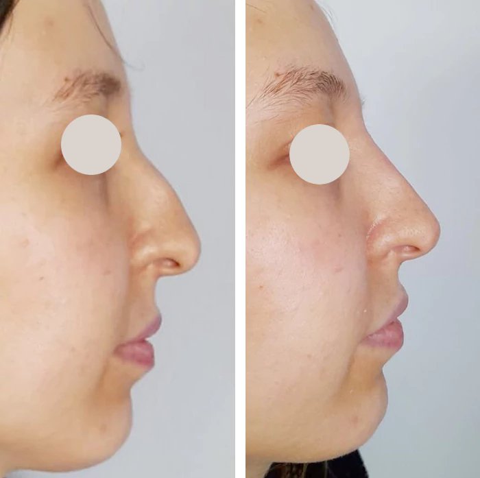 before & after photo of Nose Filler