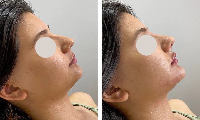 before & after photo of Nose Filler