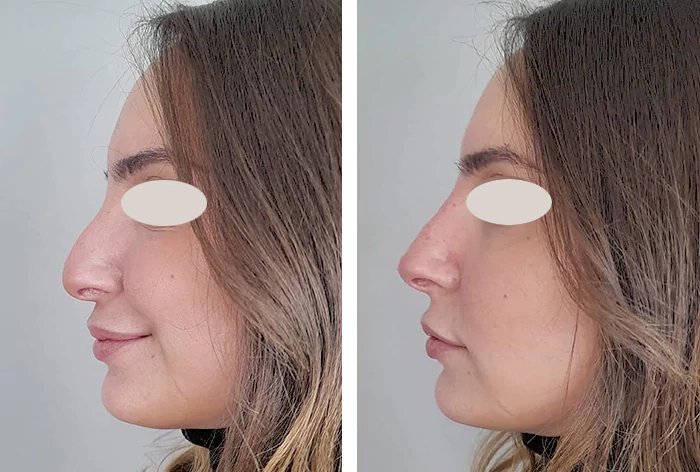 before & after photo of Nose Filler