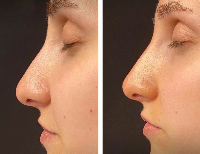 before & after photo of Nose Filler