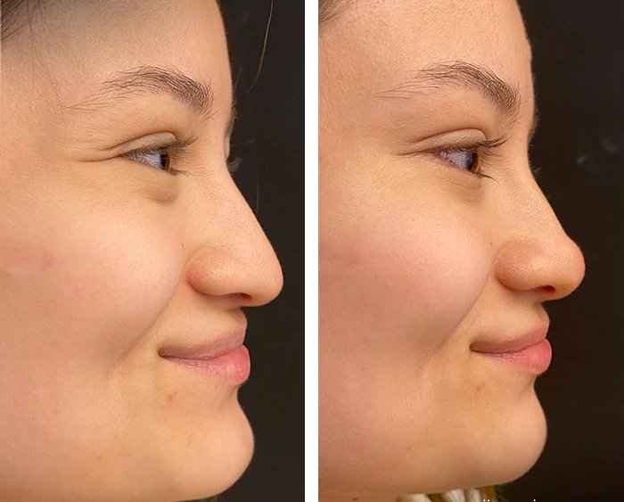 before & after photo of Nose Filler