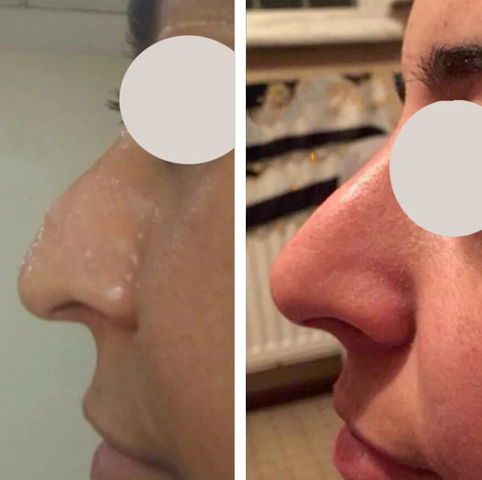 before & after photo of Thread Lift