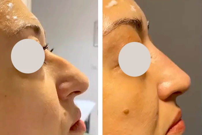 before & after photo of Nose Filler