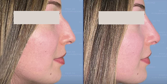 before & after photo of Rhinoplasty