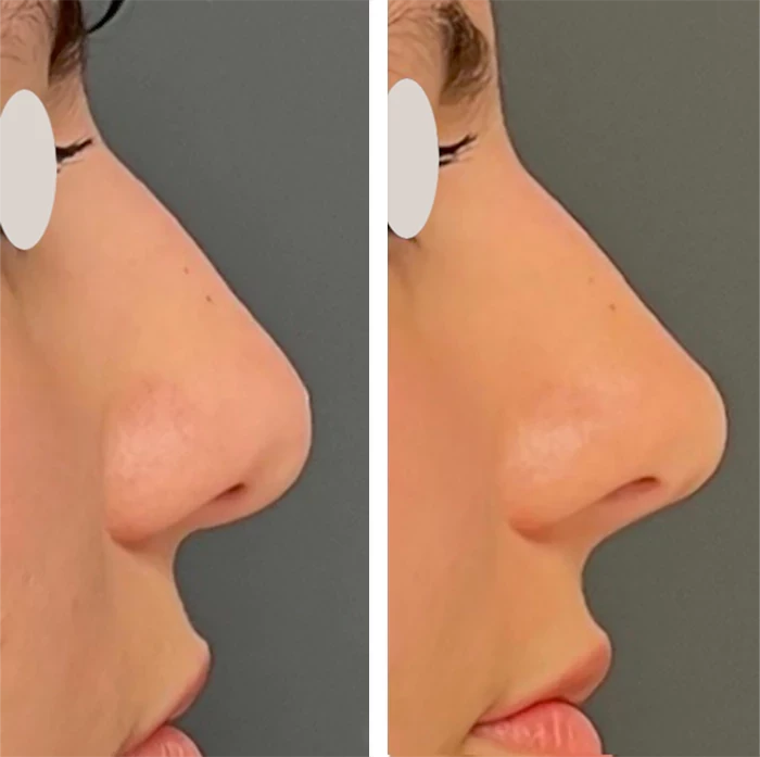 before & after photo of Rhinoplasty