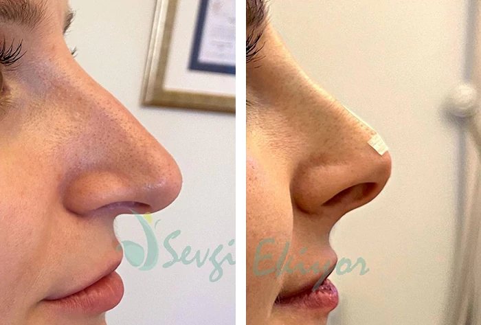 before & after photo of Nose Filler