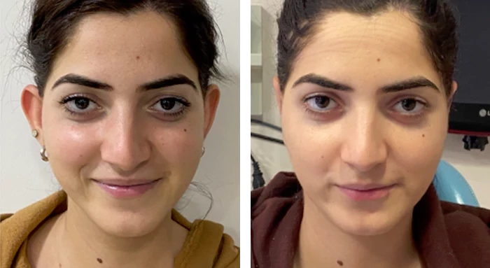 before & after photo of عملية تجميل الأذن