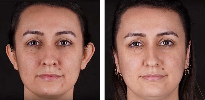 before & after photo of عملية تجميل الأذن