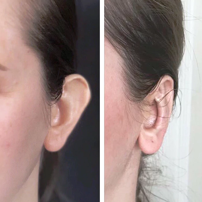 before & after photo of Rhinoplasty