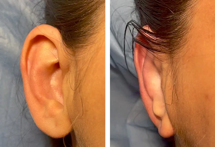 before & after photo of عملية تجميل الأذن