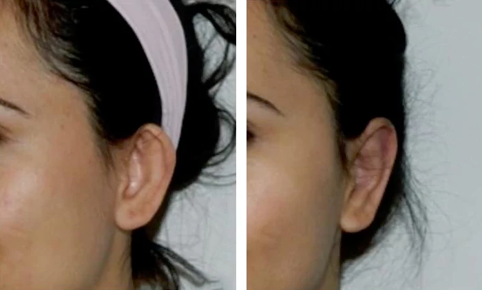 before & after photo of Otoplasty