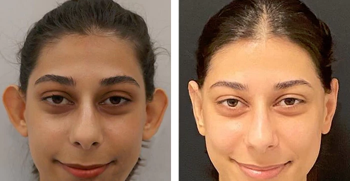 before & after photo of عملية تجميل الأذن