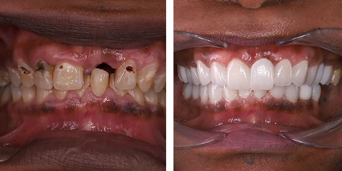 before & after photo of dental-bridge