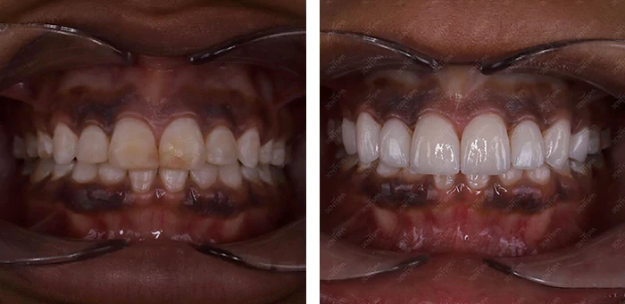 before & after photo of Dental Veneers