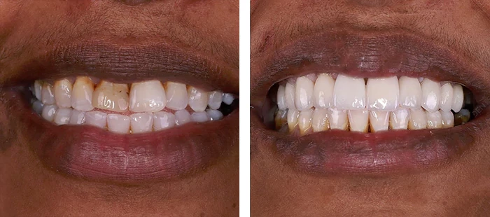 before & after photo of Dental Veneers