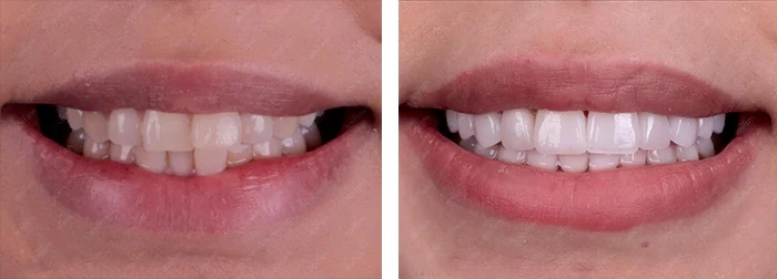 before & after photo of Dental Veneers