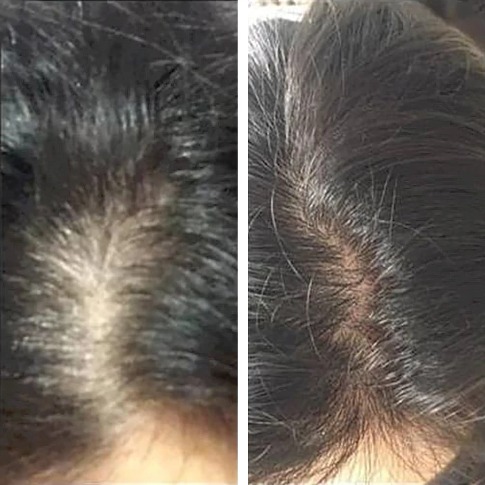 before & after photo of prp-injection