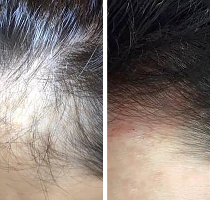 before & after photo of prp-injection