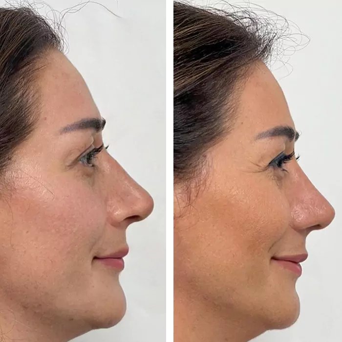 before & after photo of Rhinoplasty