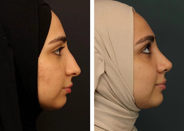 before & after photo of عملية تجميل الأذن