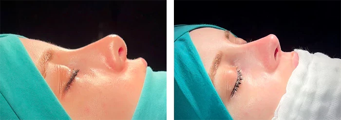 before & after photo of عملية تجميل الأنف