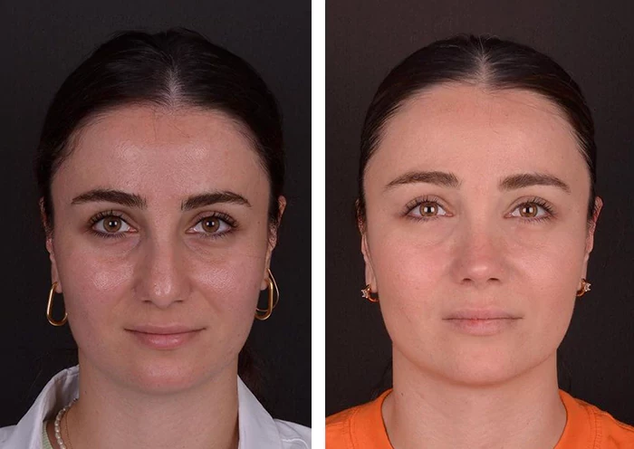 before & after photo of عملية تجميل الأنف