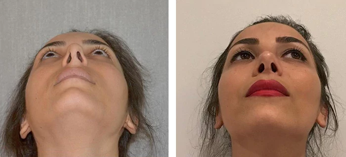 before & after photo of عملية الأنف الترميمية